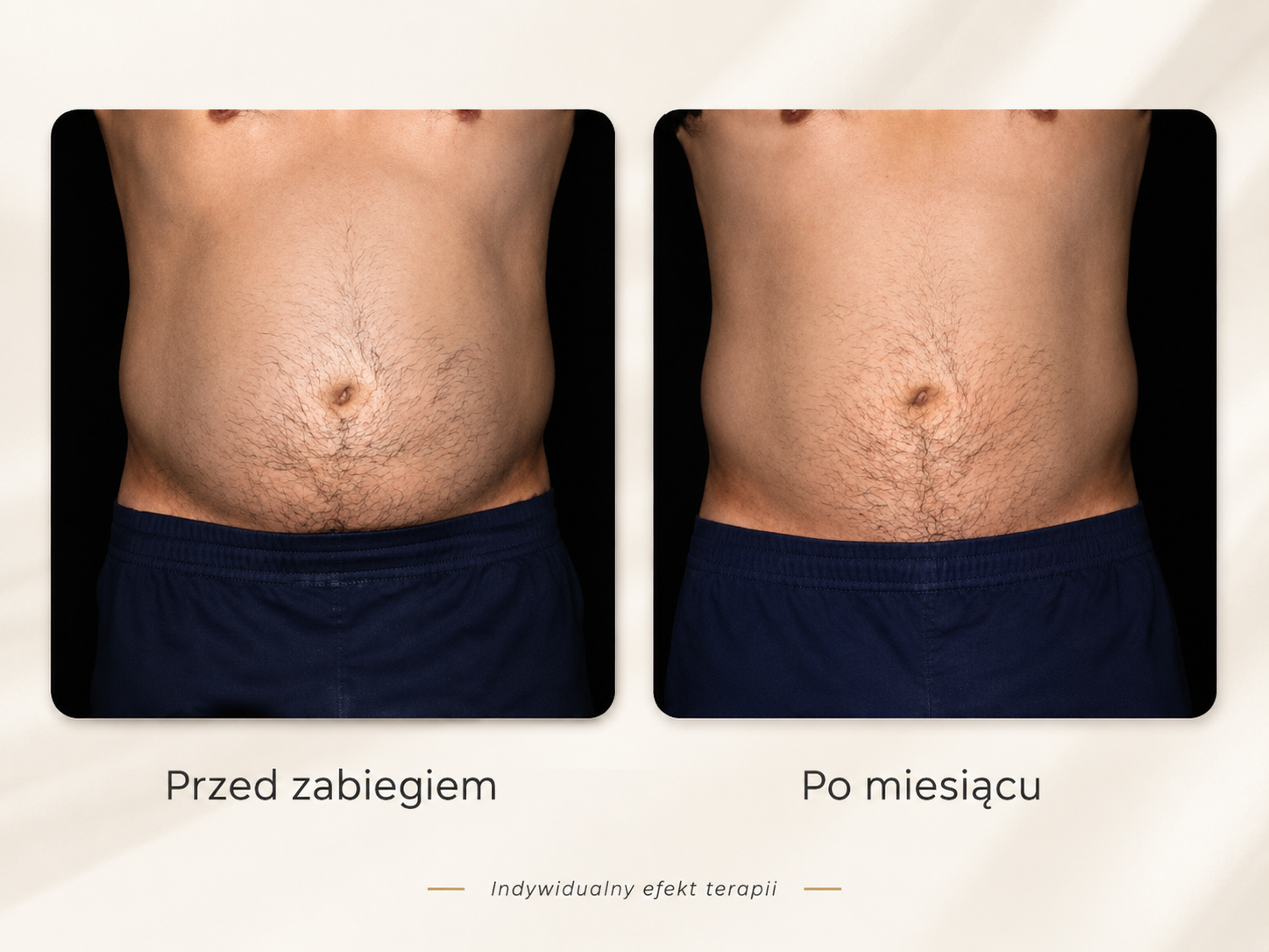 Efekty Alma PrimeX przed i po – brzuch mężczyzny po miesiącu terapii