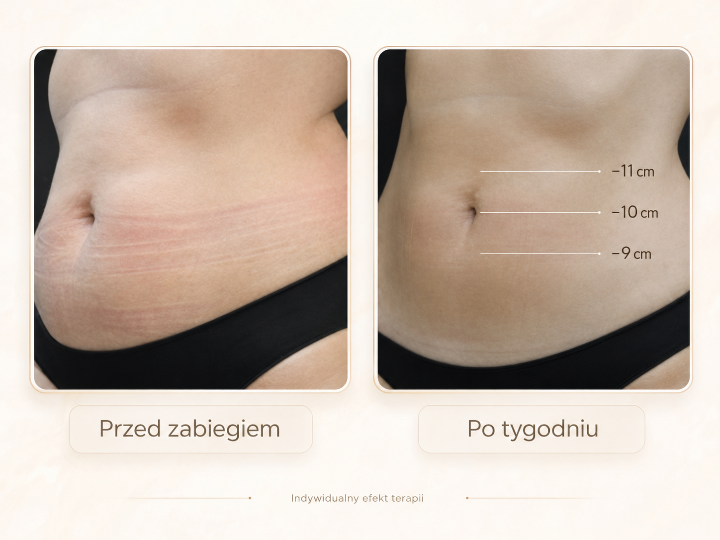Efekty Alma PrimeX przed i po – brzuch kobiety, redukcja obwodu po tygodniu