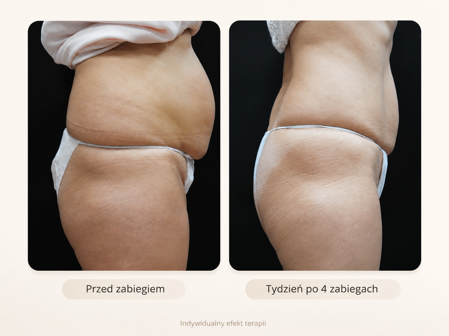 Efekty Alma PrimeX przed i po – boczki i biodra po 4 zabiegach